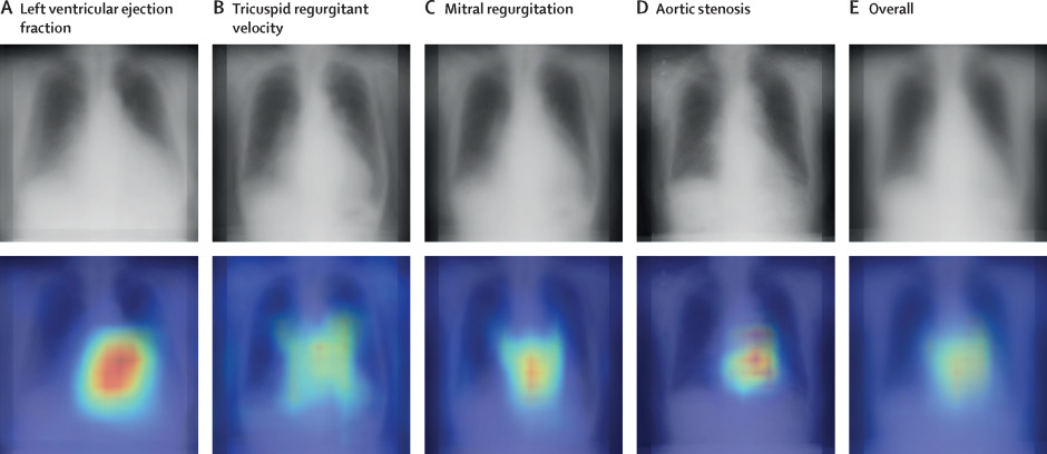 胸部レントゲンから心機能と弁膜症を同時推定するAIモデルに関する多施設研究