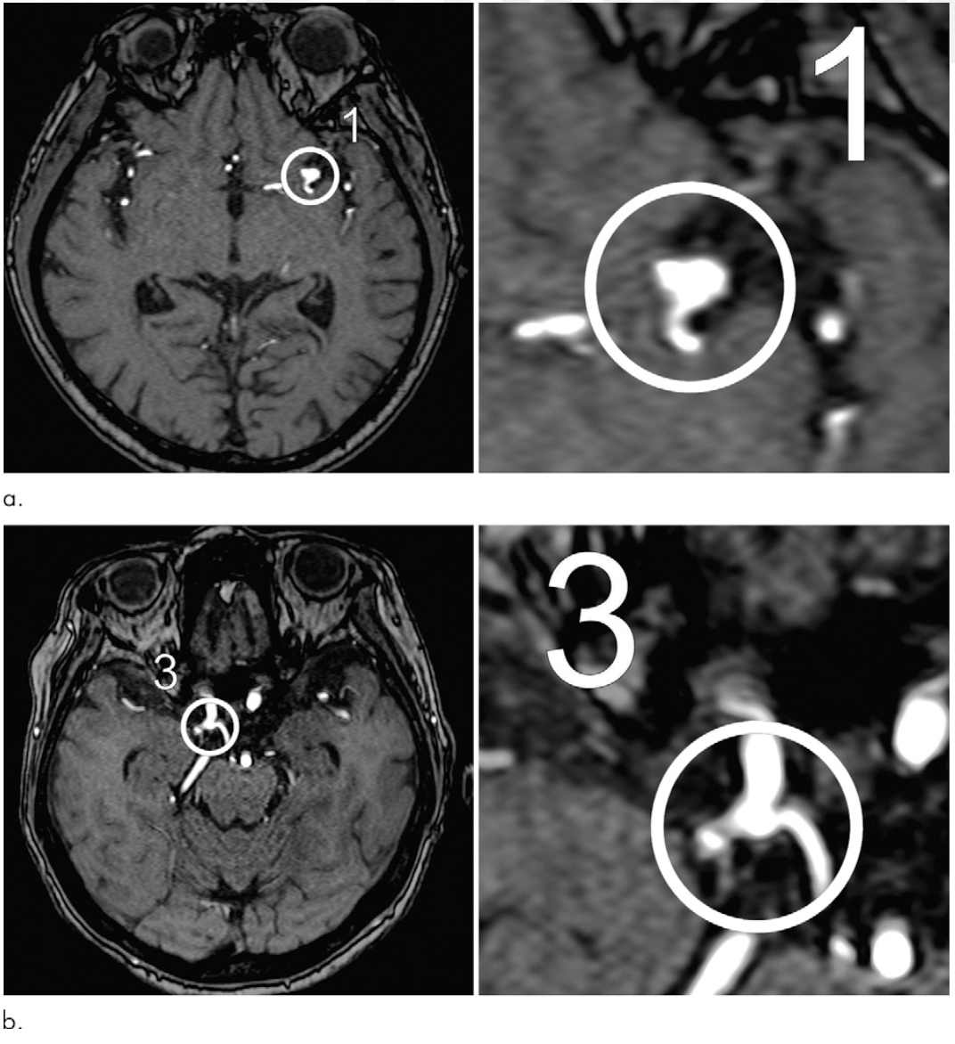 Deep Learningを用いたMRAによる脳動脈瘤自動検出の研究