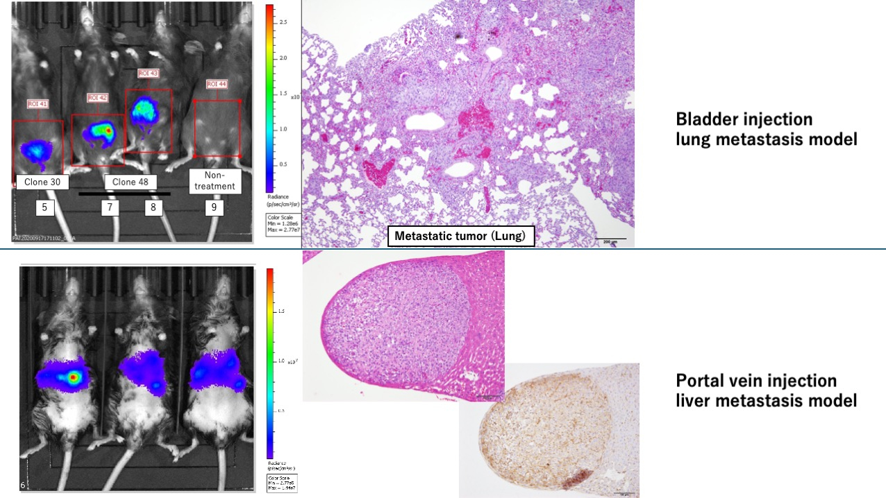 metastatic tumor